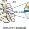 脊柱管狭窄症による腰痛や坐骨神経痛を治す方法。